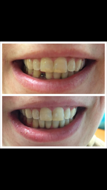 Bright Smiles Cosmetic & Implant Dentistry | 1444 Kempsville Rd #101, Virginia Beach, VA 23464, USA | Phone: (757) 497-8611