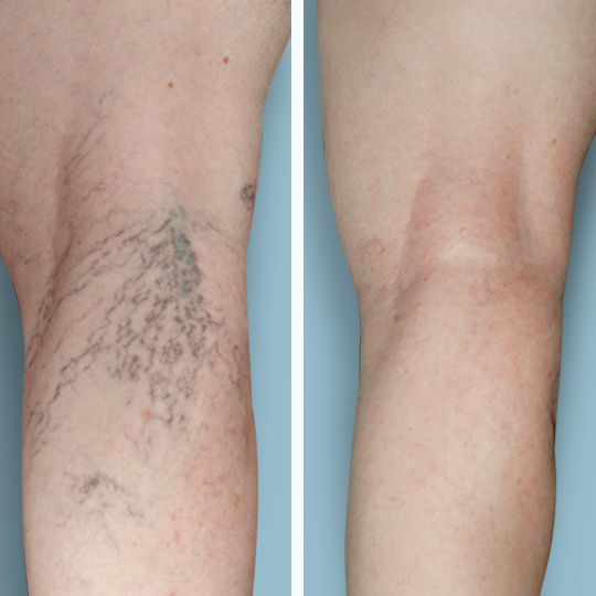 Metro Vein Centers | Brick | 525 Jack Martin Blvd Ste 200, Brick Township, NJ 08724, USA | Phone: (732) 374-9217