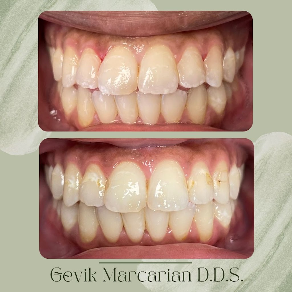 Gevik Marcarian DDS | 16661 Ventura Blvd #611, Encino, CA 91436, USA | Phone: (818) 285-0528