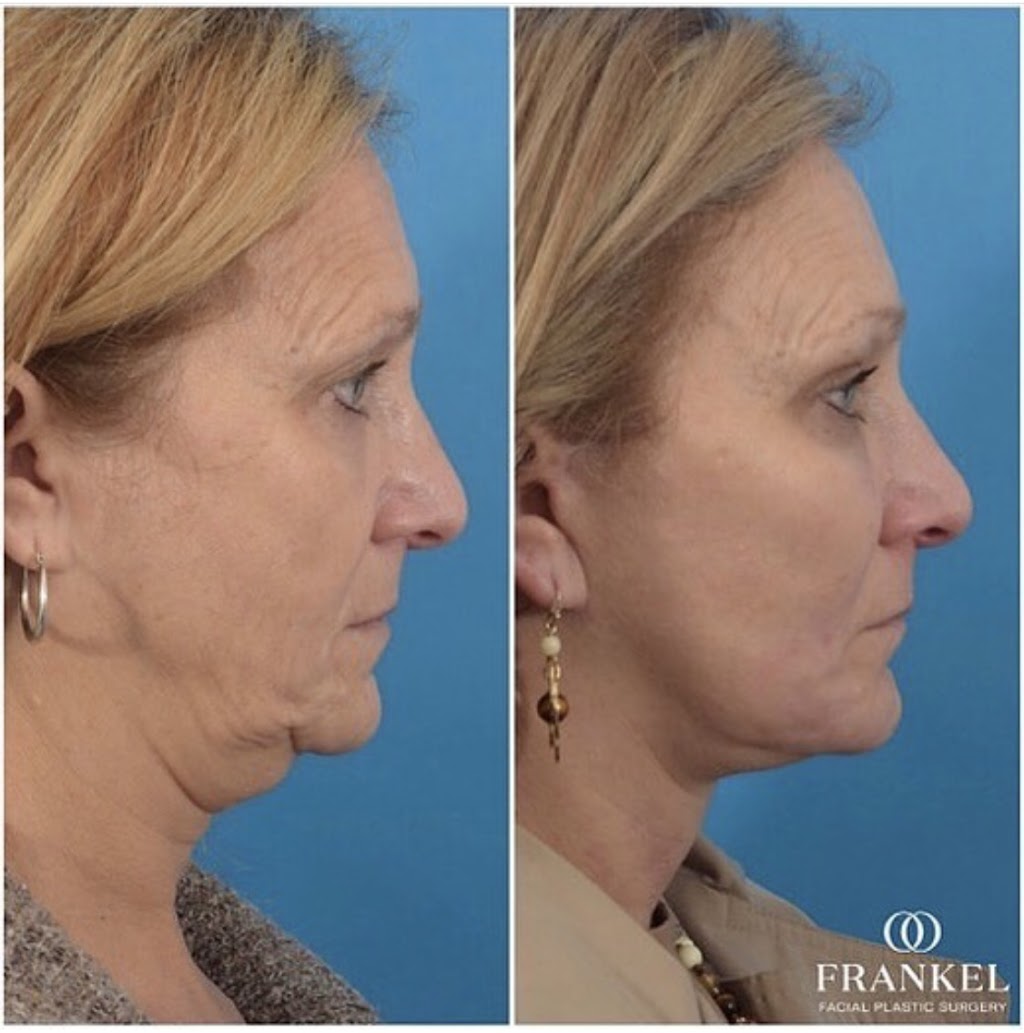 Frankel Facial Plastic Surgery, LLC: Jonathan Frankel, MD | 5885 Landerbrook Dr Suite 150, Mayfield Heights, OH 44124, USA | Phone: (216) 399-9550