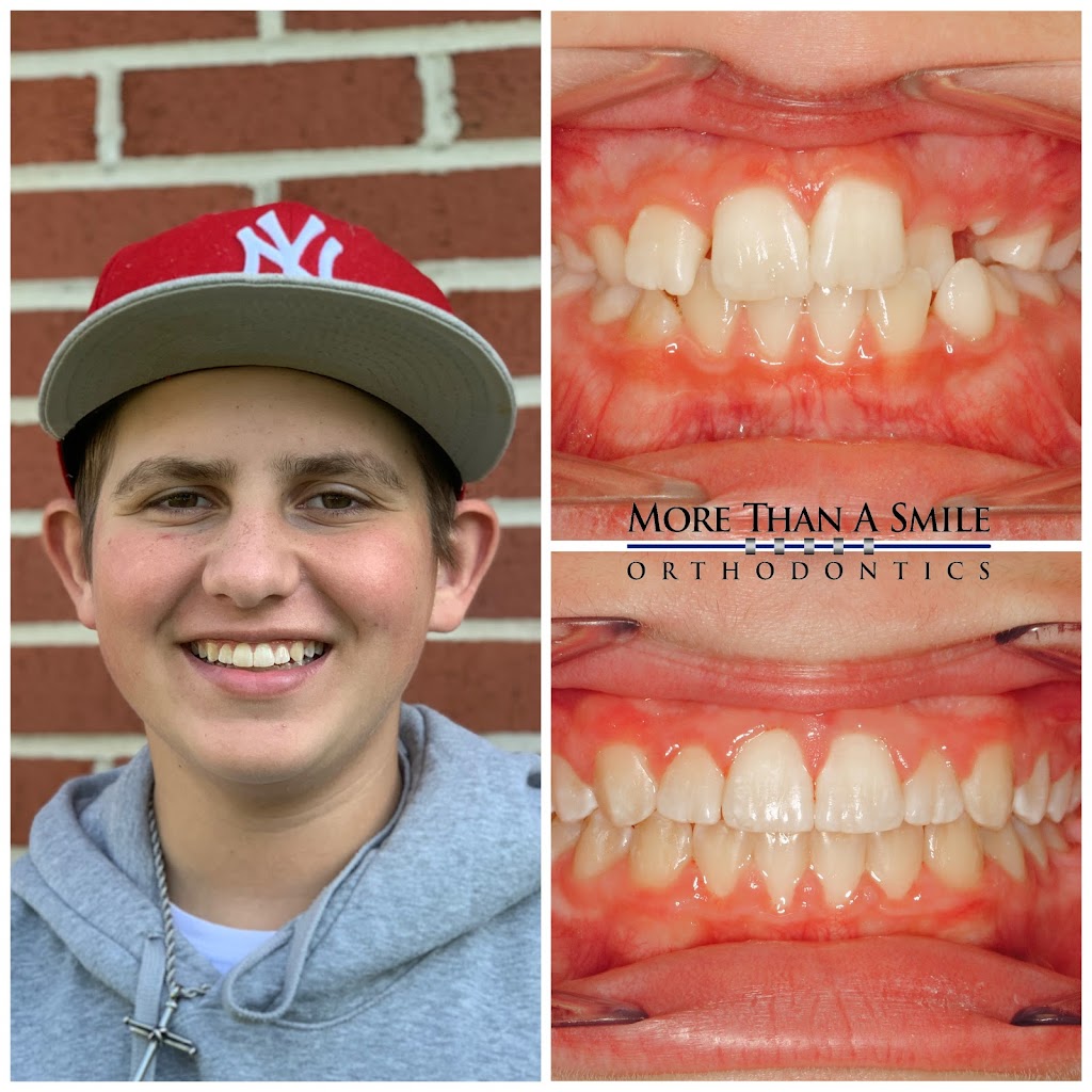 More Than A Smile Orthodontics | 2185 Bullis Rd, Elma, NY 14059, USA | Phone: (716) 652-0140