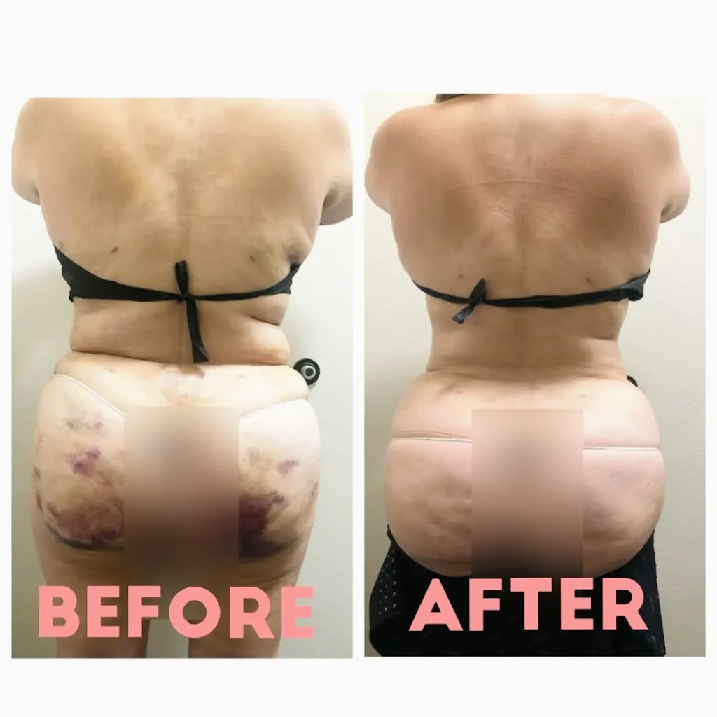 Lotus Body Contouring & Post-Lipo | 2572 Hamner Ave, Norco, CA 92860, USA | Phone: (818) 942-5693