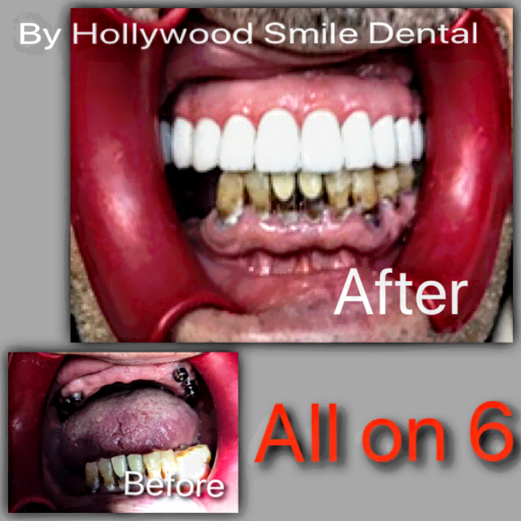Hollywood Smile Dental | 97-50 Queens Blvd, Rego Park, NY 11374, USA | Phone: (718) 830-0110