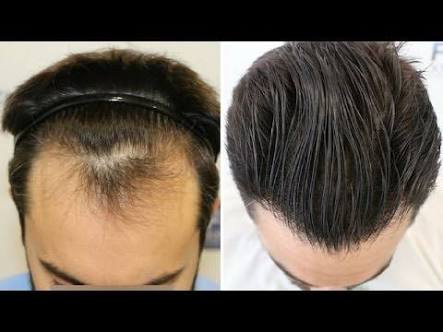 Plasmamedica Hair Transplant Istanbul Turkey | 2425 w 22nd St#205, Oak Brook, IL 60523, USA | Phone: (630) 280-7449