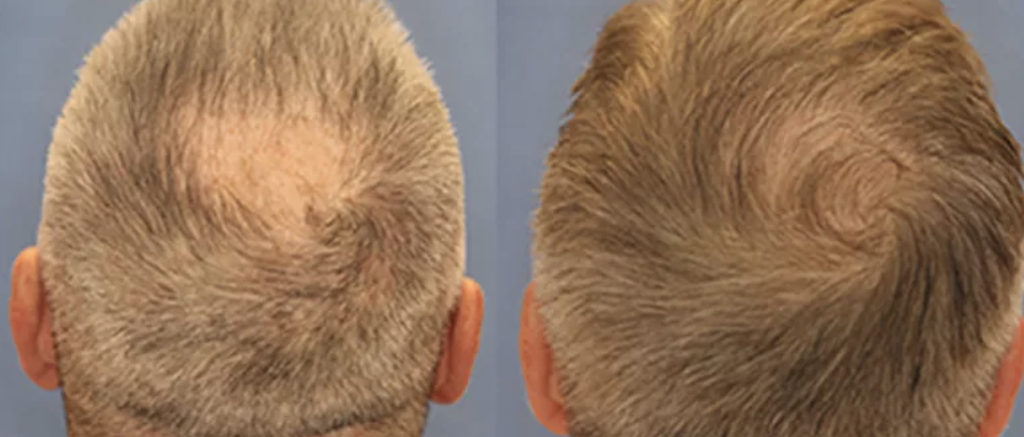 FUE Hair Transplant Solution New Jersey | 4057 Asbury Ave Suite 021, Tinton Falls, NJ 07753, USA | Phone: (848) 420-9970