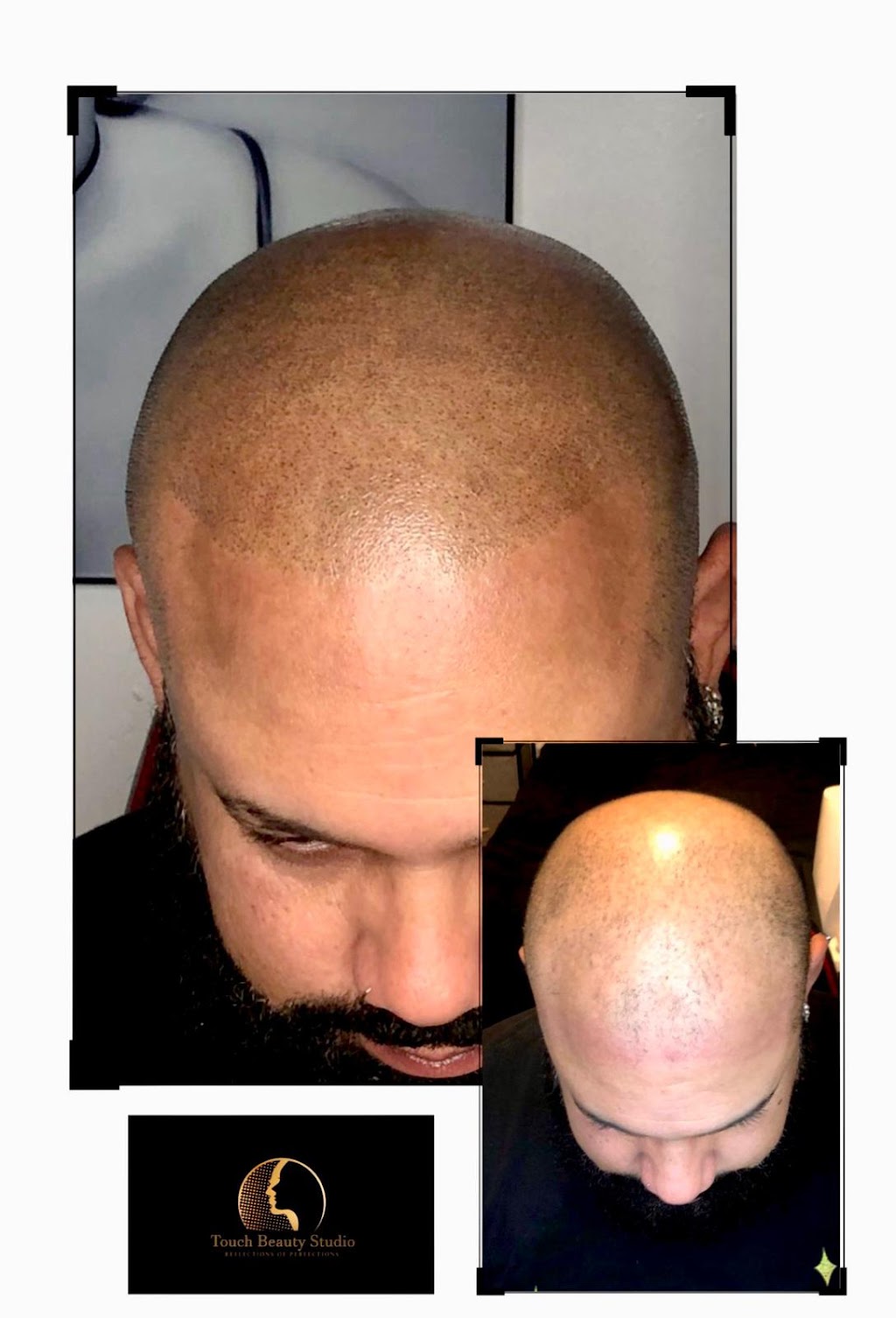 TBS SCALP MICROPIGMENTATION | 304 E 178th St, Bronx, NY 10457, USA | Phone: (646) 655-8483