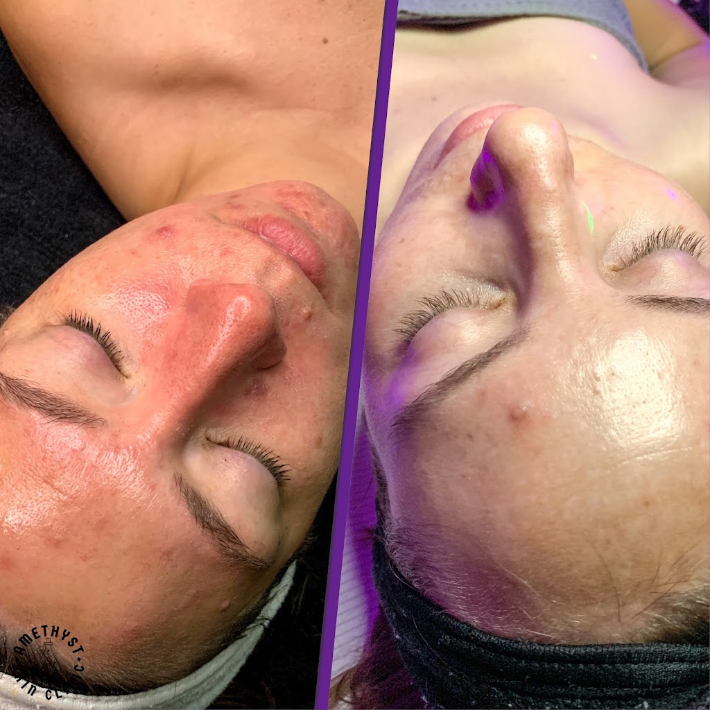 Amethyst Skin Clinic | 1061 North Dobson Rd. #110 Suite 7, Mesa, AZ 85201, USA | Phone: (480) 620-0735