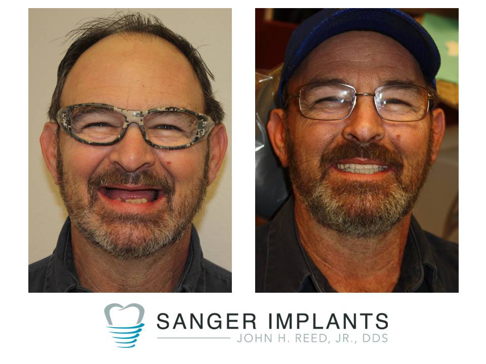 Sanger Implants | 1670 W Chapman Dr, Sanger, TX 76266, USA | Phone: (940) 458-5000