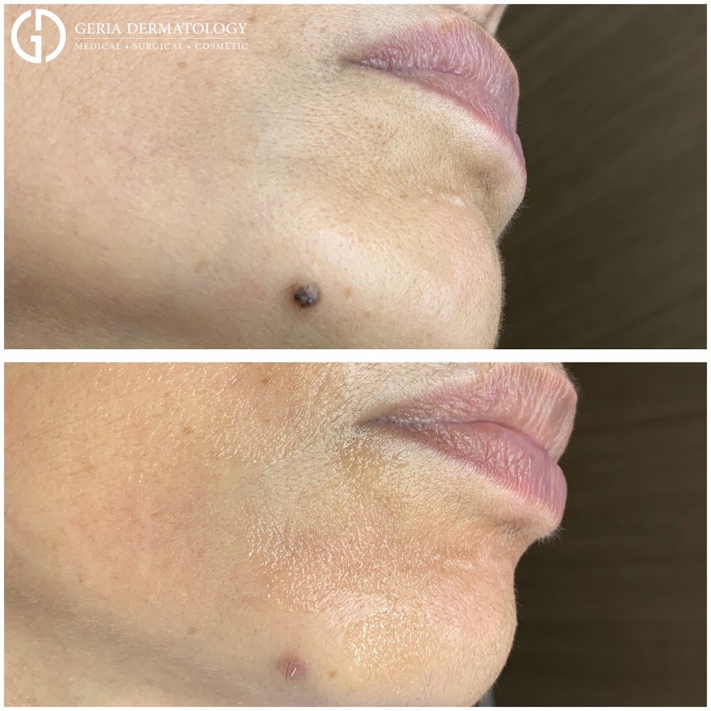 Geria Dermatology | 75 Orient Way Suite 204, Rutherford, NJ 07070, USA | Phone: (201) 623-8000