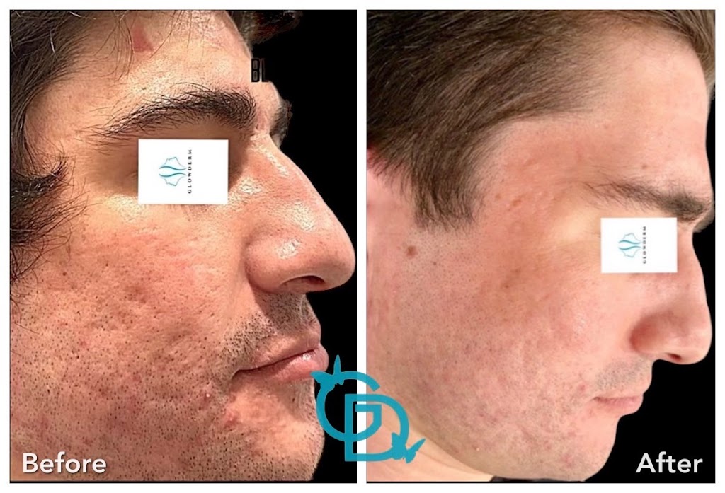 Glow DermSolutions San Jose | 6950 Santa Teresa Blvd STE E, San Jose, CA 95119, USA | Phone: (408) 794-5503 Glow DermSolutions San Jose | 6950 Santa Teresa Blvd STE E, San Jose, CA 95119, USA | Phone: (408) 794-5503