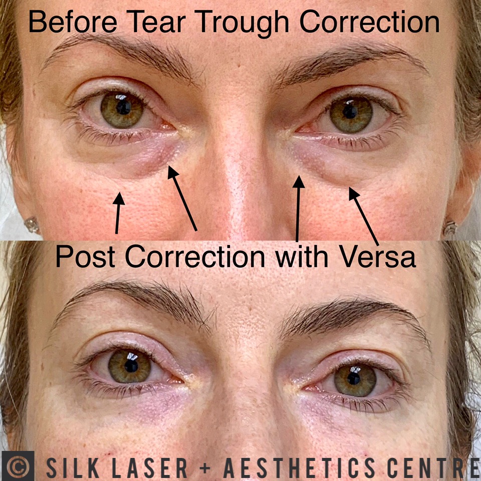 Silk Laser + Aesthetics Centre | 924 N Federal Hwy, Fort Lauderdale, FL 33304, USA | Phone: (954) 462-7455