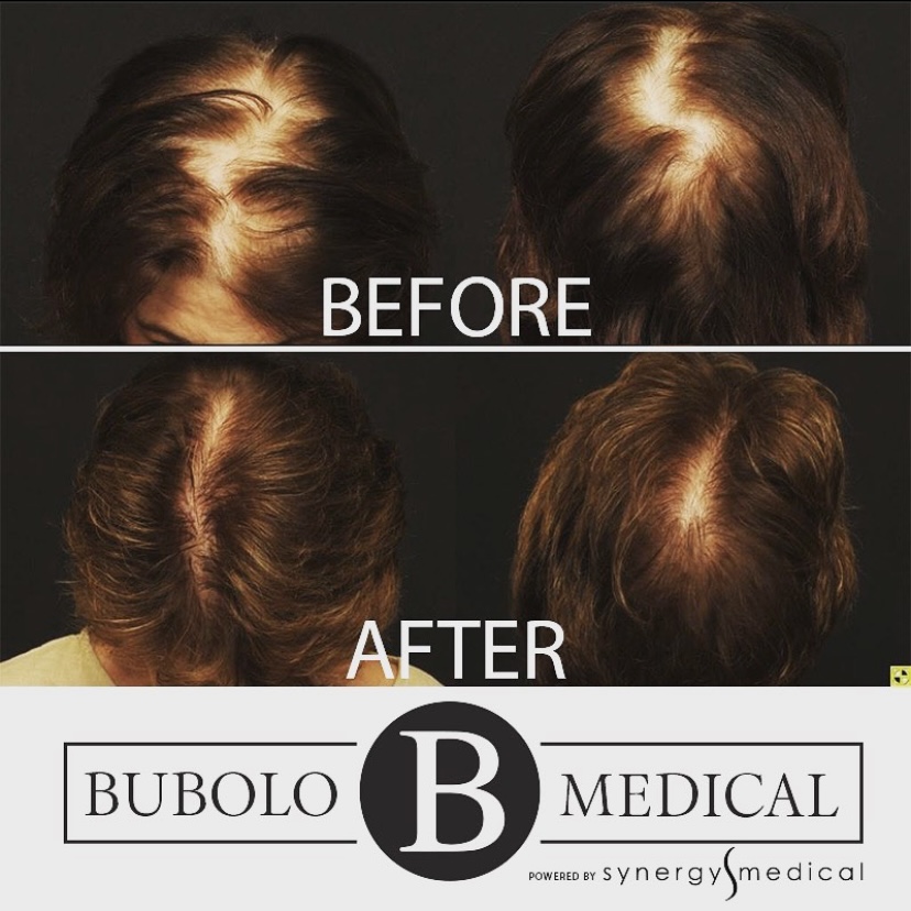 Bubolo Hair Restoration | 3889 Cobb Pkwy NW, Acworth, GA 30101, USA | Phone: (770) 766-8374