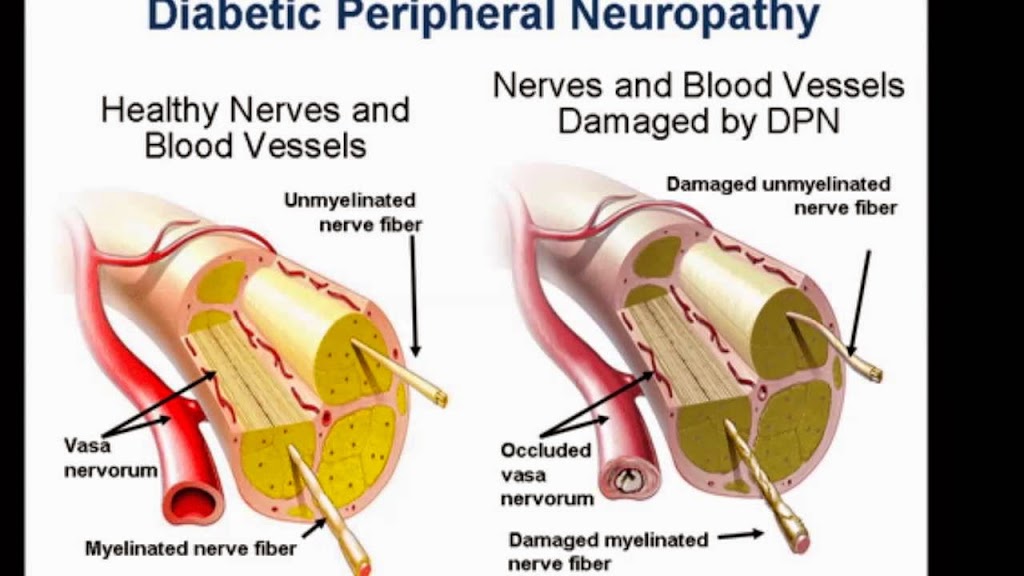 Atlanta Neuropathy Treatment Center | 4535 Winters Chapel Rd, Atlanta, GA 30360, USA | Phone: (770) 285-7246