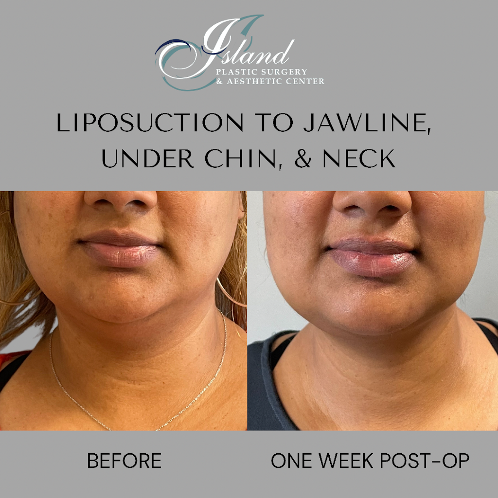 Island Plastic Surgery | 190 E Jericho Turnpike Suite 202, Mineola, NY 11501, USA | Phone: (516) 977-9922