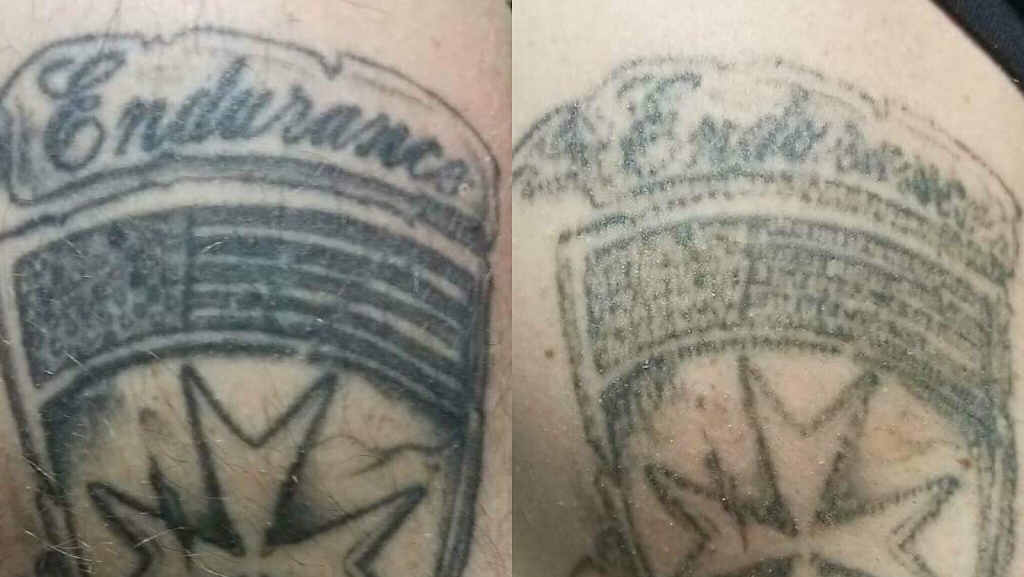 CS Tattoo Removal | 5 S Allen St #2201, Albany, NY 12208, USA | Phone: (518) 689-0730