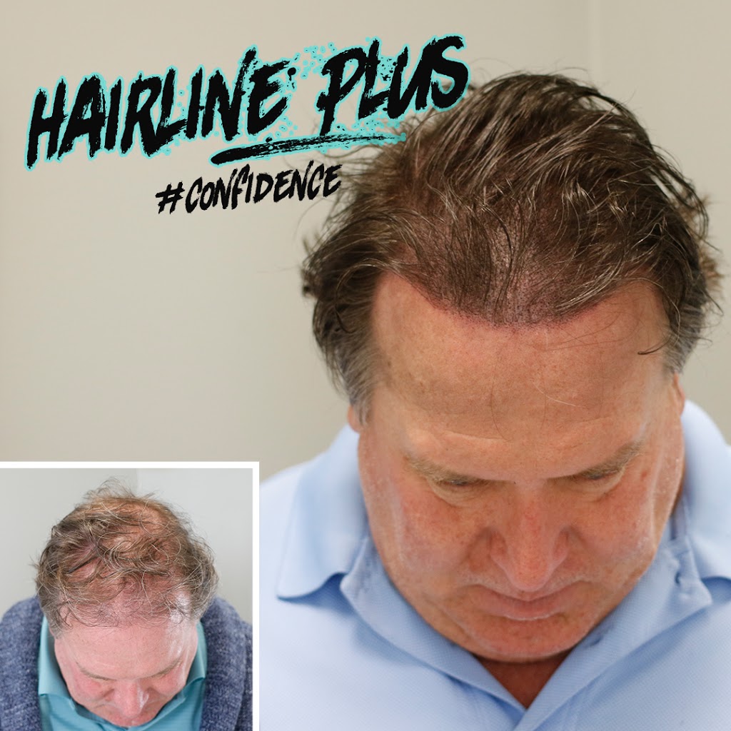 Hairline Plus | 1050 Stuyvesant Ave, Union, NJ 07083, USA | Phone: (908) 318-4018
