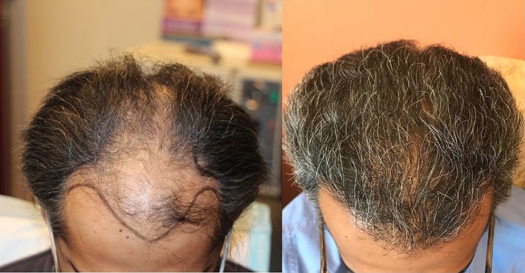 Modena Hair Transplant Institute | 2629 W Horizon Ridge Pkwy Suite #110, Henderson, NV 89052, USA | Phone: (702) 966-5134 Modena Hair Transplant Institute | 2629 W Horizon Ridge Pkwy Suite #110, Henderson, NV 89052, USA | Phone: (702) 966-5134