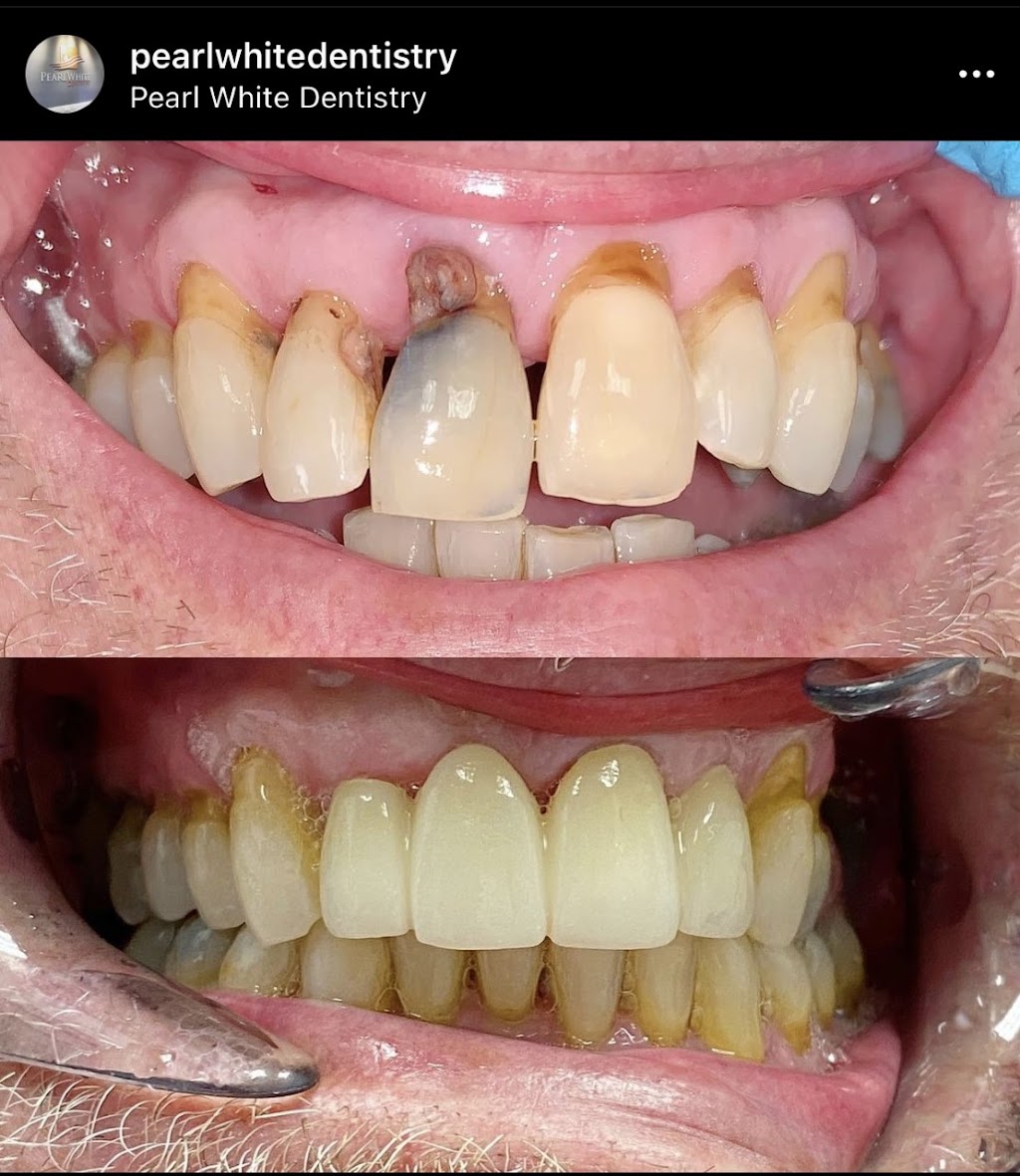 Pearl White Dentistry | 6361 N Andrews Ave, Fort Lauderdale, FL 33309, USA | Phone: (954) 491-8812