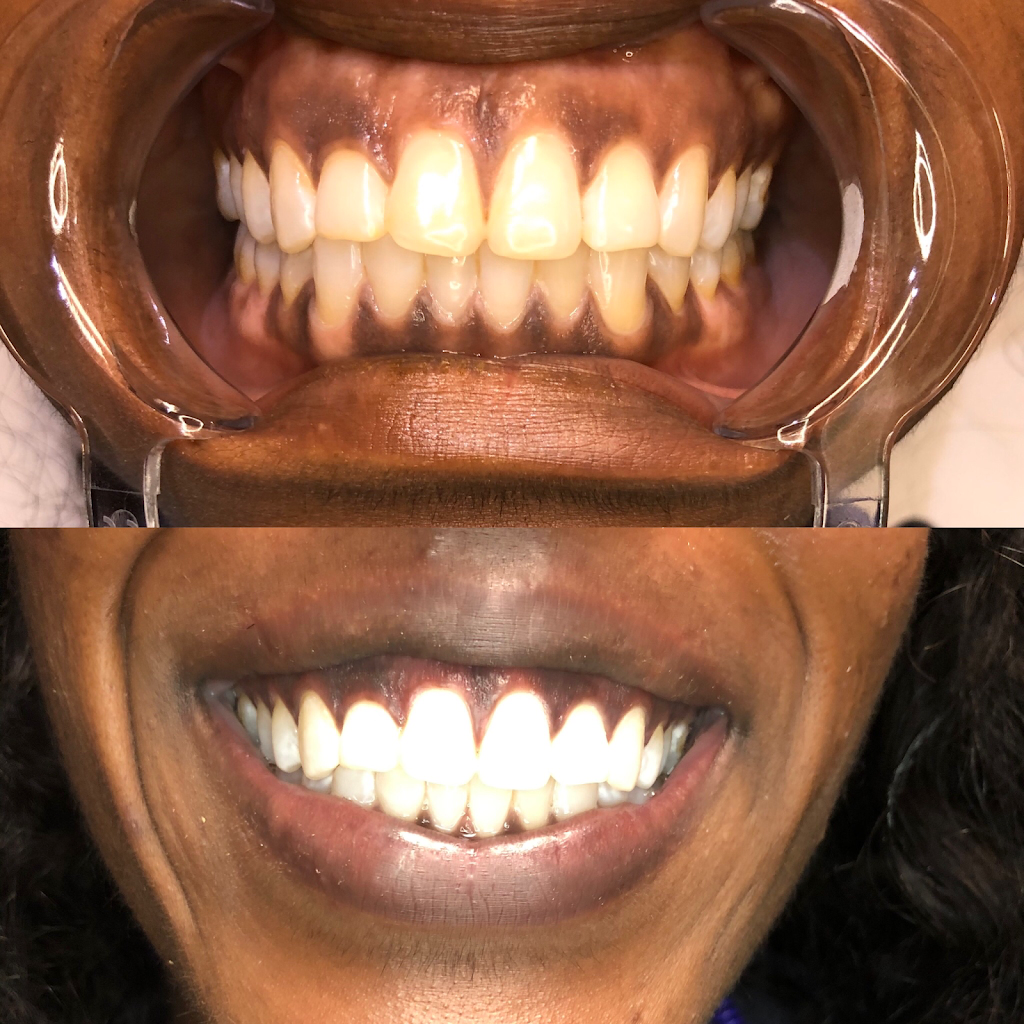 New Smiles Teeth Whitening | 222 Grifford Dr, Kissimmee, FL 34758, USA | Phone: (407) 279-0490