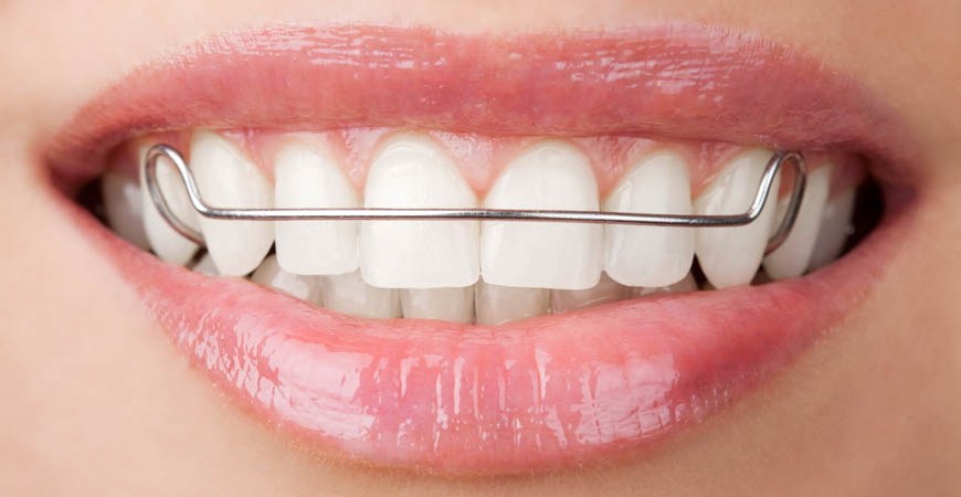 Ernstberger Orthodontics | 1003 N Main St, Salem, IN 47167, USA | Phone: (812) 944-6759