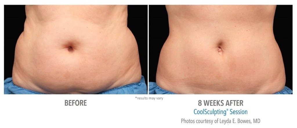 CoolSculpting of Dayton | 9240 Marketplace Dr, Miamisburg, OH 45342, USA | Phone: (937) 404-2665