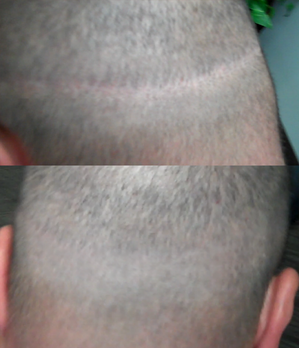 DermiMatch Scalp Micropigmentation | 7320 E Deer Valley Rd Suite 100-A, Scottsdale, AZ 85255, USA | Phone: (480) 788-2432