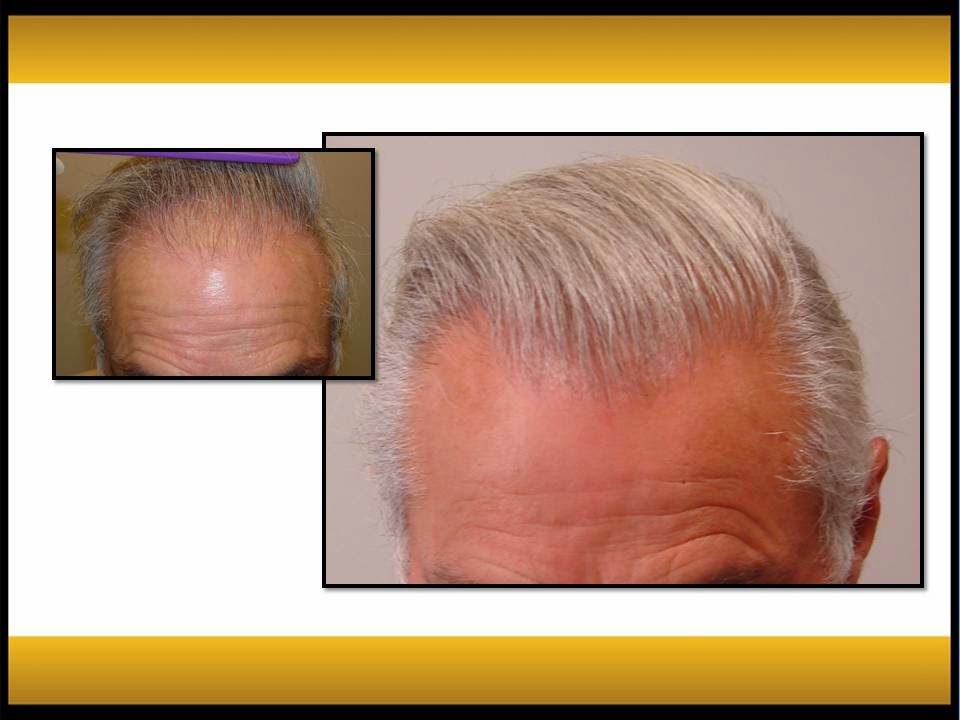 Fallon Hair Restoration | 9735 SW Shady Ln, Tigard, OR 97223, USA | Phone: (503) 941-5029