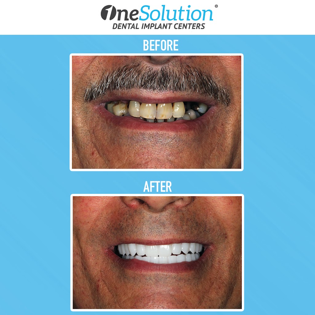 OneSolution® Dental Implant Centers | 7420 NW 5th St Suite 109, Plantation, FL 33317, USA | Phone: (877) 421-0584