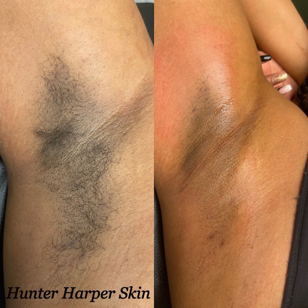 Hunter Harper Skin | 24120 Meadowbrook Rd, Novi, MI 48375, USA | Phone: (313) 314-1059