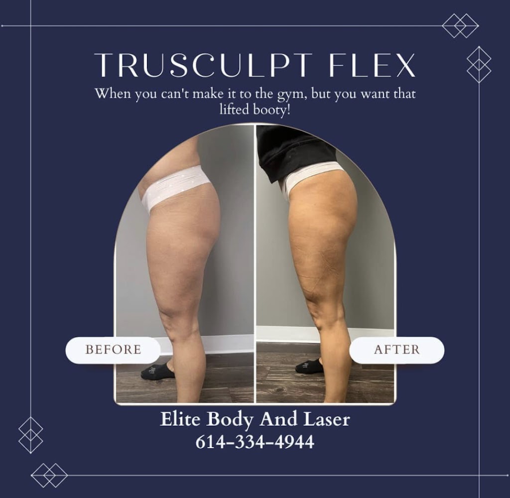 Elite Body and Laser Center | 60 Powell Rd, Lewis Center, OH 43035, USA | Phone: (614) 334-4944