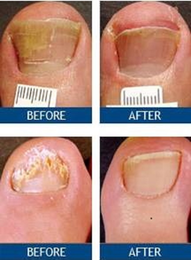 Laser Nail Therapy | 23 Atlantic Ave, Freeport, NY 11520, USA | Phone: (516) 256-8771