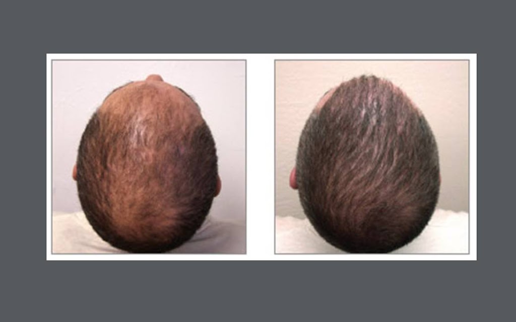 Buffalo Hair Transplant Center | 5007 Transit Rd Suite #2, Depew, NY 14043, USA | Phone: (716) 428-3998