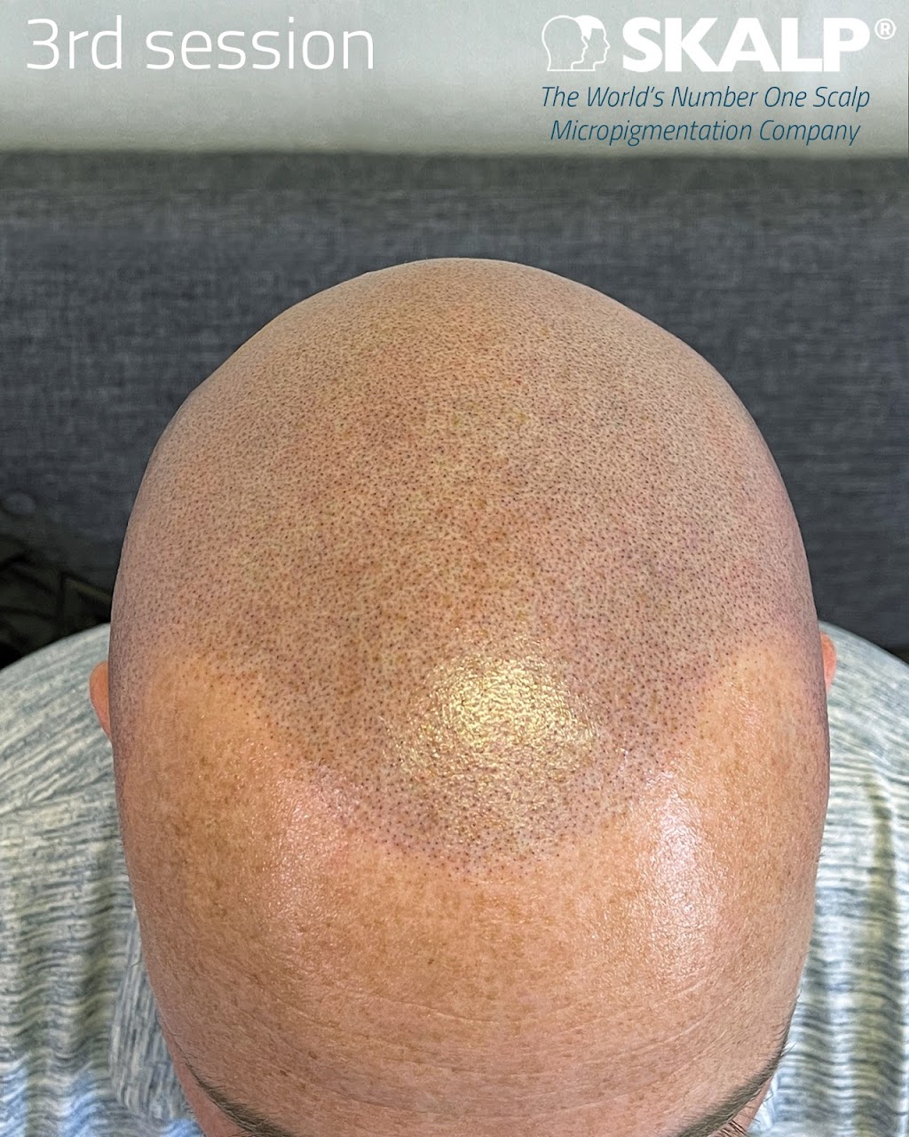 Skalp | Los Angeles Scalp Micropigmentation Clinic | 6735 Westminster Blvd. Suite 105, Westminster, CA 92683, USA | Phone: (323) 400-3595