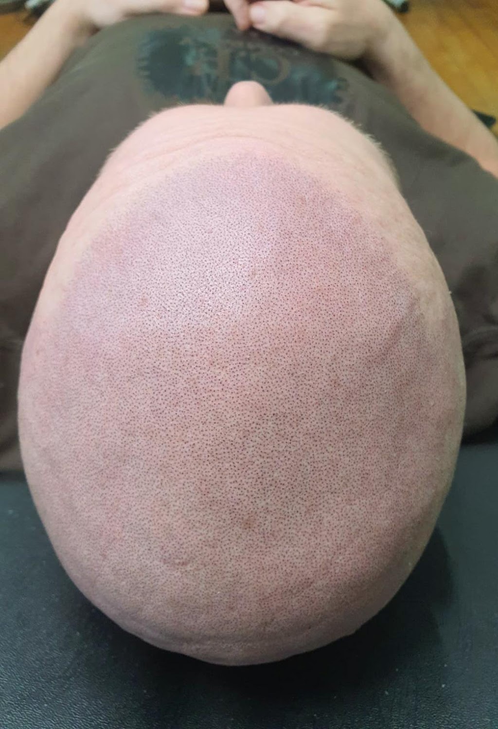 Skalp | Los Angeles Scalp Micropigmentation Clinic | 6735 Westminster Blvd. Suite 105, Westminster, CA 92683, USA | Phone: (323) 400-3595