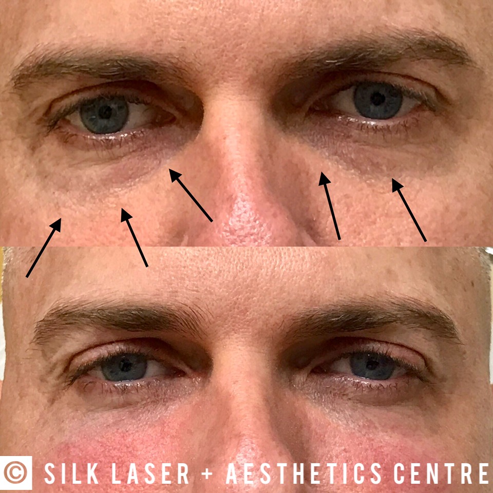 Silk Laser + Aesthetics Centre | 924 N Federal Hwy, Fort Lauderdale, FL 33304, USA | Phone: (954) 462-7455