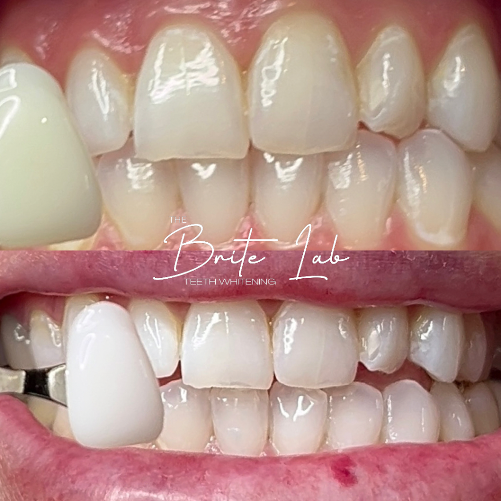 The Brite Lab Teeth Whitening | 22597 Barton Rd Ste. D, Grand Terrace, CA 92313, USA | Phone: (909) 566-1340