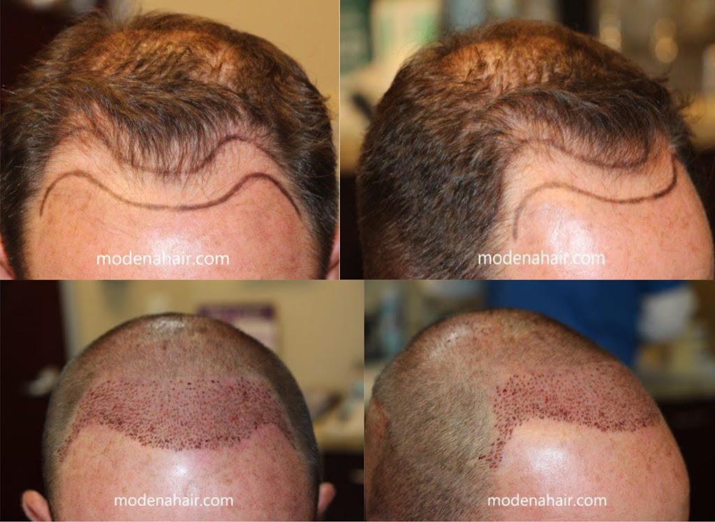 Modena Hair Transplant Institute | 2629 W Horizon Ridge Pkwy Suite #110, Henderson, NV 89052, USA | Phone: (702) 966-5134 Modena Hair Transplant Institute | 2629 W Horizon Ridge Pkwy Suite #110, Henderson, NV 89052, USA | Phone: (702) 966-5134