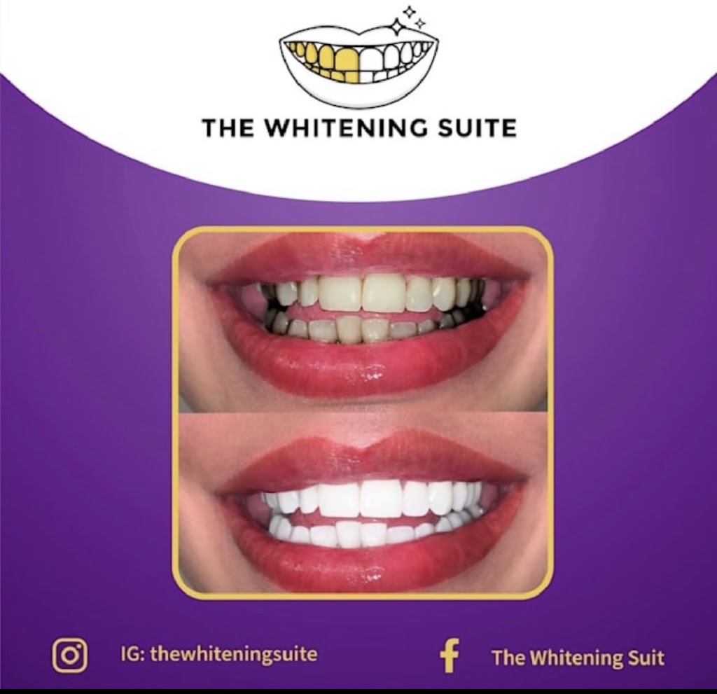 The Whitening Suite (Mobile Service only, We go to you) | 602 Mantoloking Rd Unit 2, Brick Township, NJ 08723, USA | Phone: (732) 859-7436
