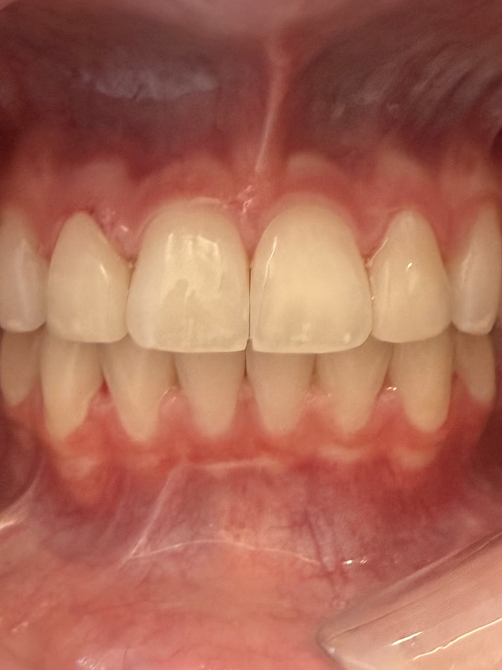 Tennyson Lake Dental | 5044 Tennyson Pkwy STE A, Plano, TX 75024, USA | Phone: (945) 322-7462