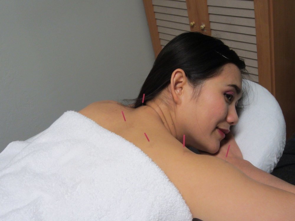 Best Care Acupuncture | 22227 Redwood Rd, Castro Valley, CA 94546, USA | Phone: (510) 881-1198