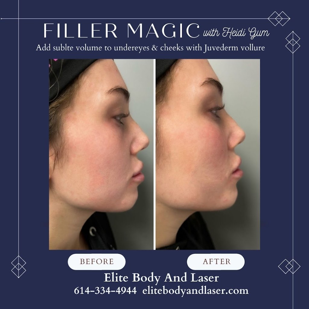 Elite Body and Laser Center | 60 Powell Rd, Lewis Center, OH 43035, USA | Phone: (614) 334-4944