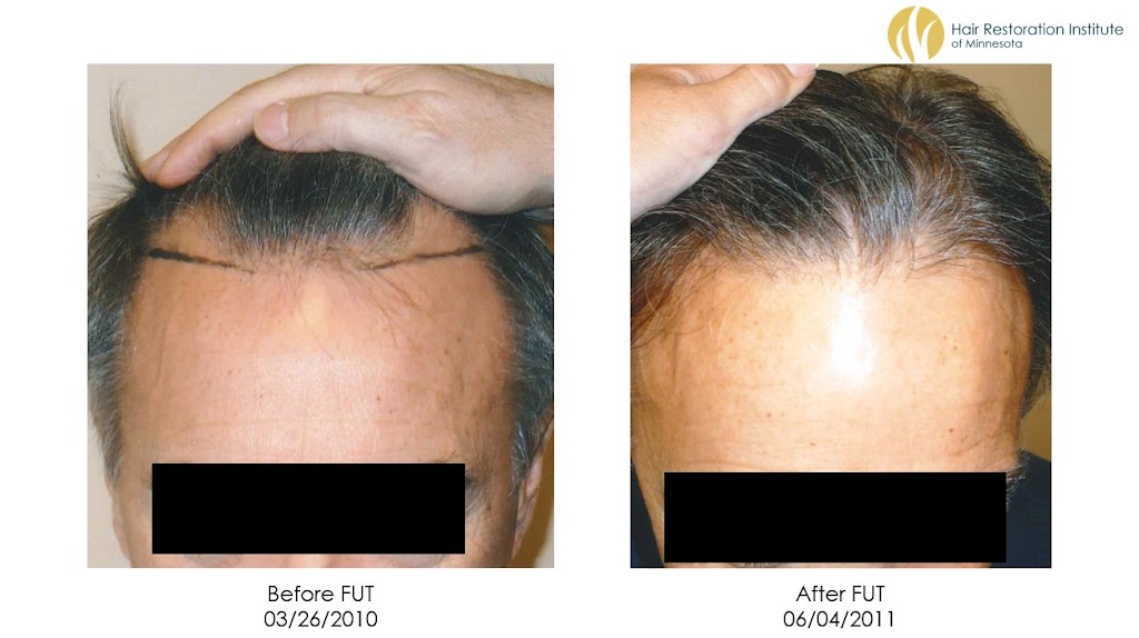 Hair Restoration Institute of Minnesota | 8009 34th Ave S Suite #1225, Bloomington, MN 55425, USA | Phone: (612) 588-4247