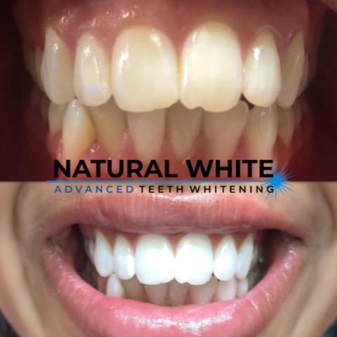 Natural White Clinical Teeth Whitening | 2993 Sandy Plains Rd Suite 125 Office 4, Marietta, GA 30066, USA | Phone: (704) 966-9090