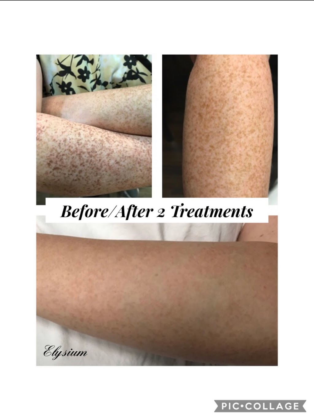 Elysium Skin & Laser | 4365 E Pecos Rd #134a, Gilbert, AZ 85297, USA | Phone: (480) 840-9319