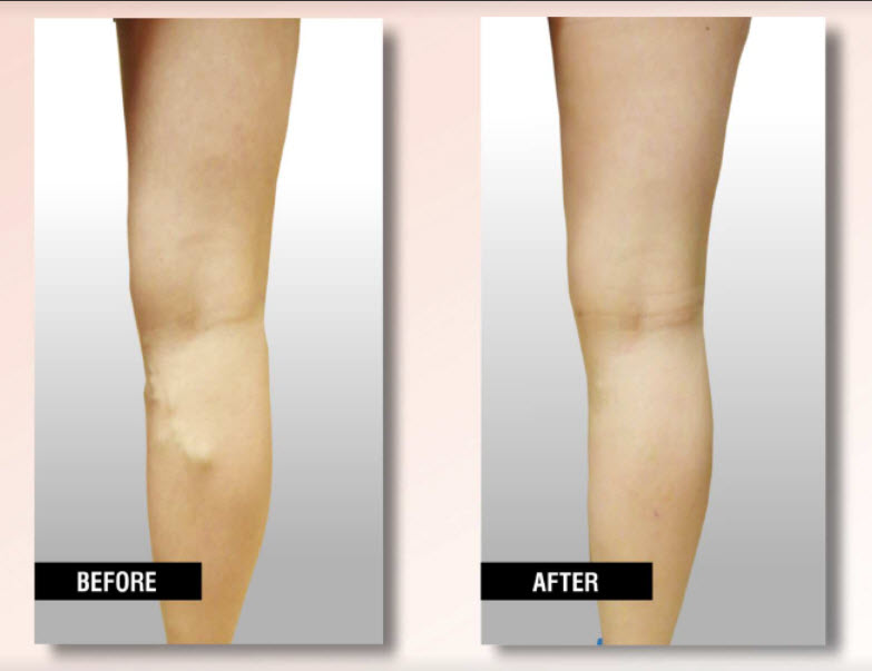 USA Vein Clinics | 6049 S Hulen St #101, Fort Worth, TX 76132, USA | Phone: (817) 672-2850