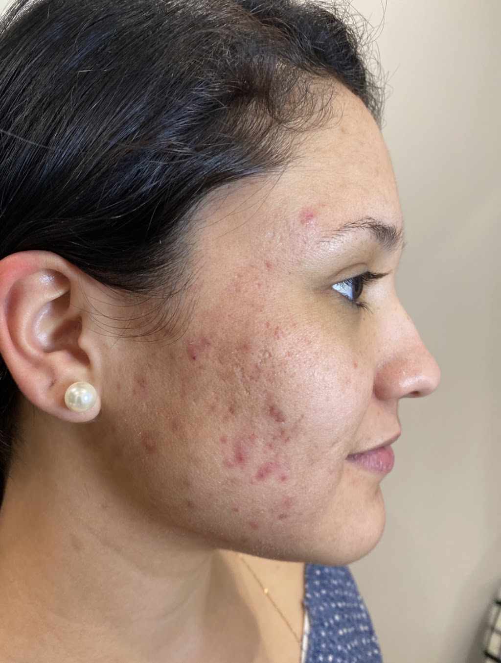 Glow DermSolutions San Jose | 6950 Santa Teresa Blvd STE E, San Jose, CA 95119, USA | Phone: (408) 794-5503 Glow DermSolutions San Jose | 6950 Santa Teresa Blvd STE E, San Jose, CA 95119, USA | Phone: (408) 794-5503