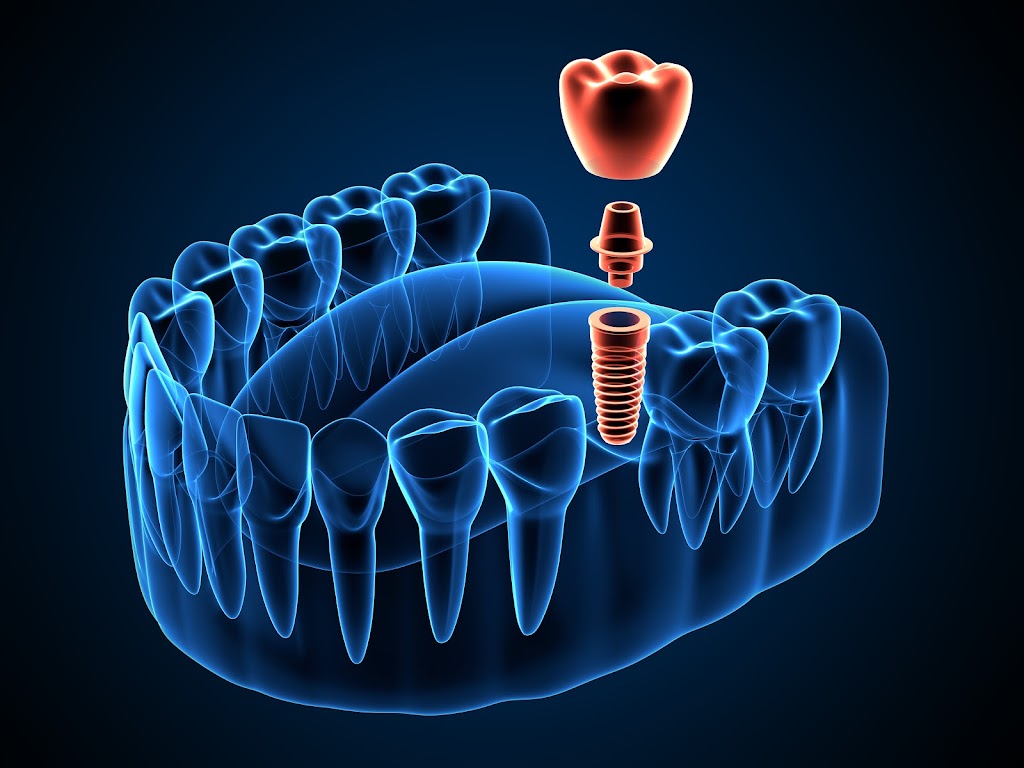 Lane Oral & Maxillofacial Surgery & Dental Implant Center | 30 Resnik Rd, Plymouth, MA 02360, USA | Phone: (508) 746-8700