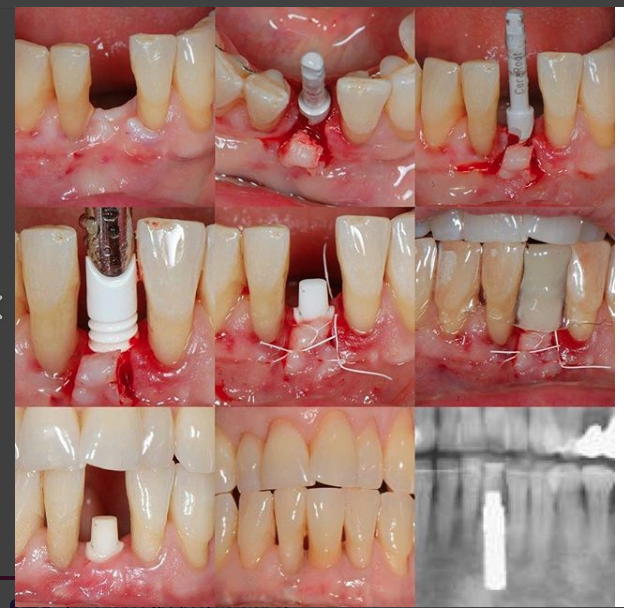 CeraRoot USA Inc. - ceramic dental implants | 2800 Neilson Way Suite 2, Santa Monica, CA 90405, USA | Phone: (800) 485-1613
