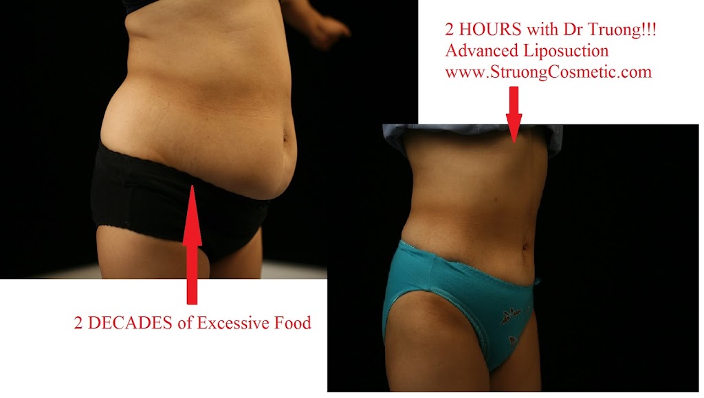 Liposuction Orange County | 16027 Brookhurst St suite i-548, Fountain Valley, CA 92708, USA | Phone: (714) 839-9999