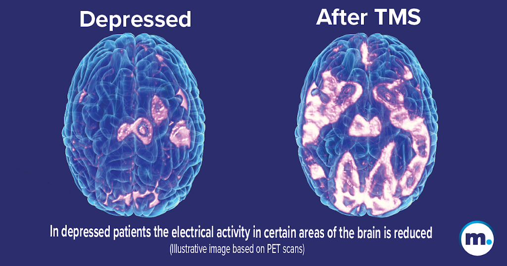 BrainStim TMS | 135 N Arlington Heights Rd Suite 105, Buffalo Grove, IL 60089, USA | Phone: (847) 654-9702